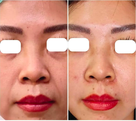 3 perawatan terbaik anti-aging di klinik Kecantikan Jakarta
